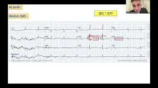 Interesting case of channelopathy/cardiomyopathy (founder mutation)