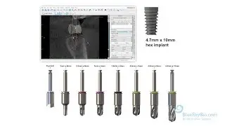 Fully Guided Keyless Hex Implant