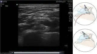 ISBPB SCANNING 3 POINT METHOD