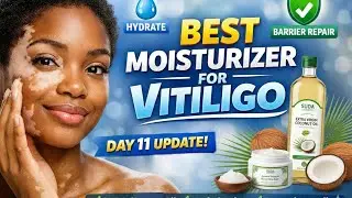 Best Moisturizer for Vitiligo &ndash; Keep White Patches Soft & Healthy