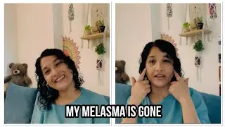 My melasma is gone naturally #melasma #pigmentation #selfcare 