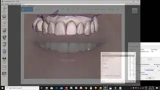 Transparent Overlay Dental Design