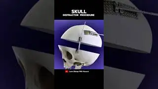 Skull distractor Procedure Animation