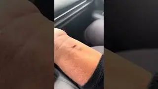 Wounds and Cuts