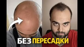 Как я вернул волосы без пересадки и победил облысение