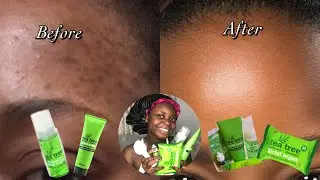 DONT USE TEA TREE PRODUCTS IF YOU HAVEN&rsquo;T DONE THIS FIRST