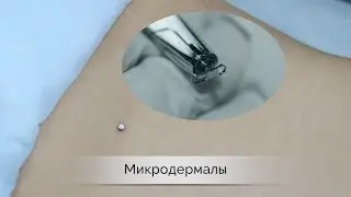 Микродермал &ndash; установка | пирсинг Самара влог | microdermal piercing