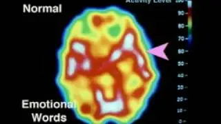 Psychopathic Personality Disorder.mp4