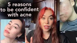how to be confident with acne!