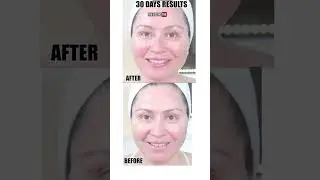30 Days with DermRays Revive &ndash; Results That Last! #beautydevice