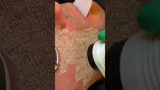 Lumenis Ultra Pulse Alpha Laser