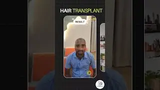Hair transplant result #shorts #short #hairtransplant #baldnesssolution #beautious_aesthetics