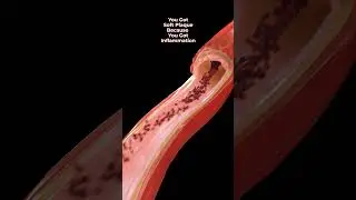 What Causes Soft Plaque? #heartattacksymptoms #heartdisease #autophagy
