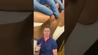 / docpods #callus little toe corn and callus removal by podiatrist corns and callus in this location