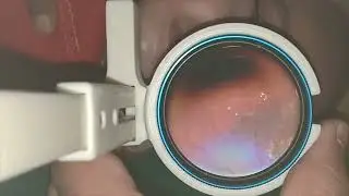 C3 FUNDUS CAM-SMARTPHONE ROP SCREENING DEVICE