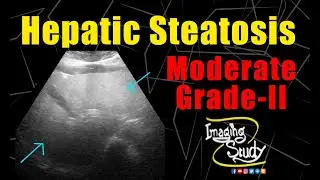 Moderate Hepatic Steatosis || Grade-II Fatty Liver || Ultrasound || Case 222