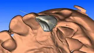 Atlantis&trade; abutments &minus; Atlantis VAD | Dentsply Sirona