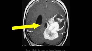 TOM HAPKA MISDIAGNOSIS VIDEO 1