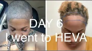 Black Female Hair Transplant FUE @HEVACLINIC -  #Istanbul #Heva #fuehairtransplant