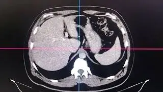 CT SCAN WHOLE ABDOMEN INTERPRETATIONS