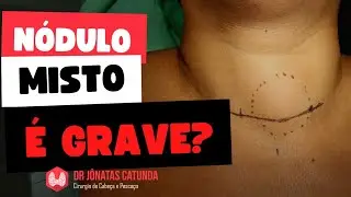 Nódulo misto na tireóide é grave? - Ao vivo respondendo perguntas