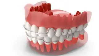 Blouk out for acrylic partial denture.استاذ امير الكردي جامعة الحلة