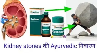 Cystone tablet and Cystone syrup full review  ( Don't miss this )  @pharmatank5632