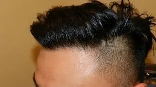 Art of Hair Transplant Hairline Restoration on Male by Dr. Diep http://www.mhtaclinic.com