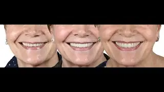 DE DIENTES DESGASTADOS Y PEQUEÑOS A SONRISA PERFECTA CON CARILLAS ULTRAFINAS