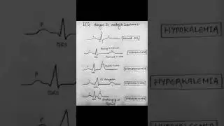 ECG changes