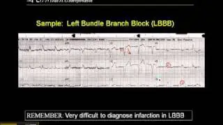 12-15 Lead ECG: Left Bundle Branch Block