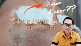 Keratosis Seboroik di Kelopak Mata? | On the Spot Laser CO2 & Harga dr. Irfan Prasetya