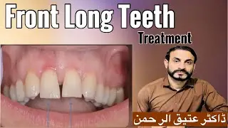 Front Teeth Too Long or Small? Best Dental Treatments 
