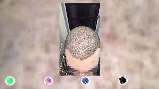 Norwood 5 6 Hair Transplant Monthly Result-Ay Ay Sa&ccedil; Ektirme Sonucu