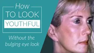 Dr Kulick Plastic Surgery San Francisco Vertical Face Lift