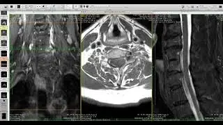 Cervical spine Imaging - from brachial plexus MRI 2025, highlighting C7