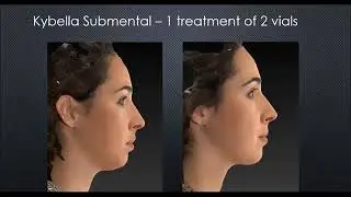 WEBINAR: What Are Your Facial Rejuvenation Options?
