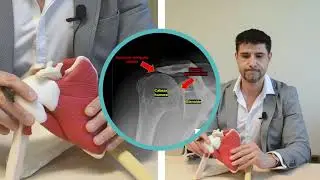 Hombro y artropatia del manguito rotador: qué es, cómo detectarla y tratarla eficazmente 💪⚡