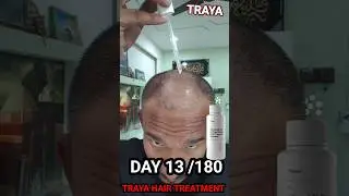 Day 13/180 | Traya Minoxidil Journey | Scalp Flakes & Hair Care Update #minoxidiljourney