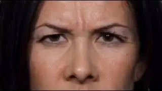 Botox Cosmetic Treatment for Forhead and Brows