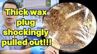 Thick wax plug shockingly pulled out | ear cleaning | ASMR earwax | soothing |relax|