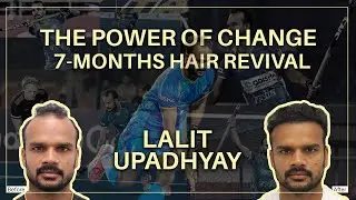 Lalit Upadhyay's Hair Transplant Journey | Real Results in Just 7 Months
