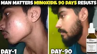 Man matters minoxidil review 90 days | minoxidil beard growth | man matters beard oil review |
