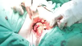 Dokteroncall: Operasi KET (Kehamilan Ektopik Terganggu) Tutorial