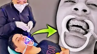 COLOQUEI APARELHO!😱 Não tô conseguindo comer.