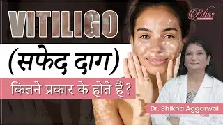 Vitiligo  Skin Disease | Vitiligo Treatment | Types of Vitiligo | Skin Specialist in Ludhiana