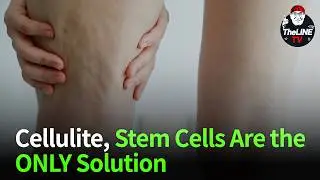 stem cell cellulite treatment #kbeauty #cellulitetreatment #thelineclinic