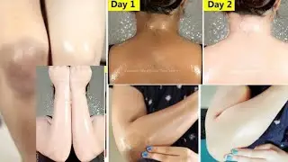  Dark neck / Hand and Body Tan Removing Easy Home Remedy. 💯 % Effective Results.