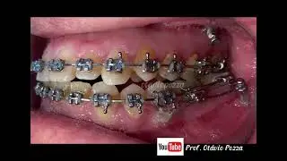 Mini-implante em Buccal Shelf para Classe II
