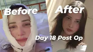 Incredible Deep Plane Facelift Before and After 